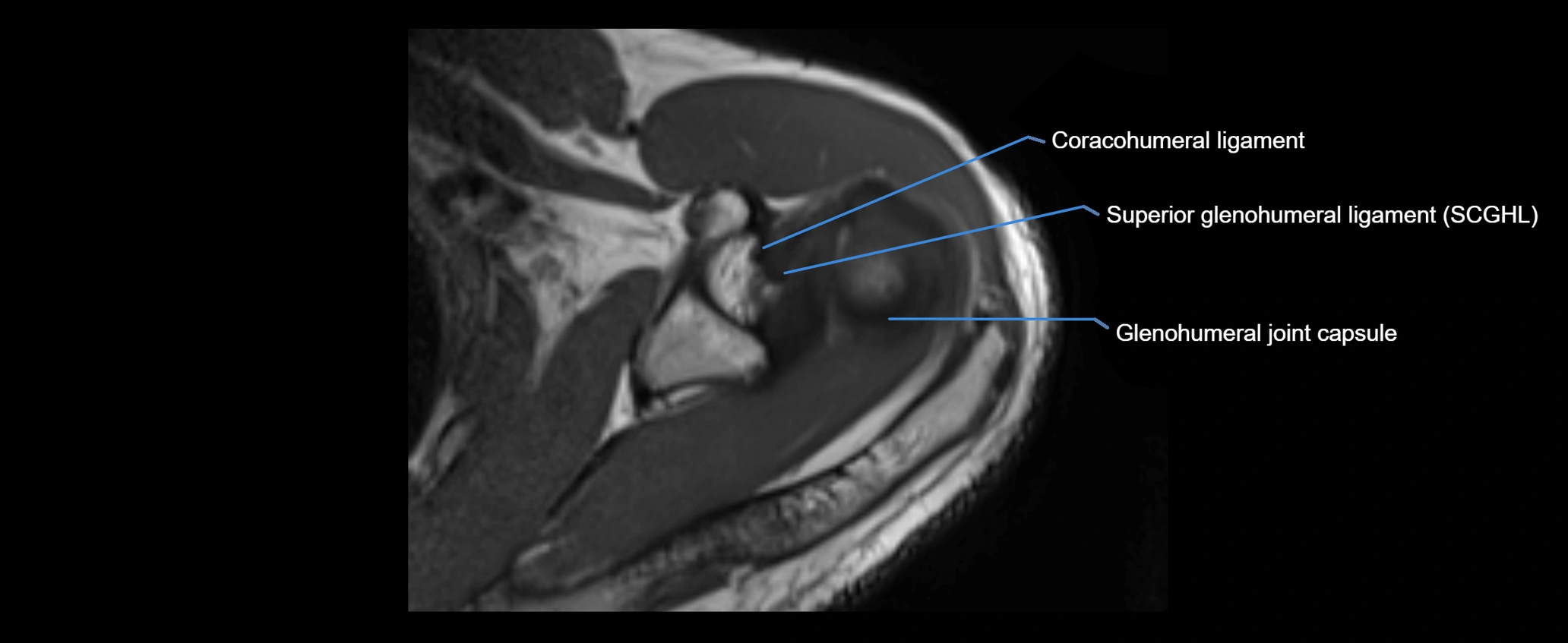 shoulder ligaments axial 3d 3t mri image-img-00005-00042.webp